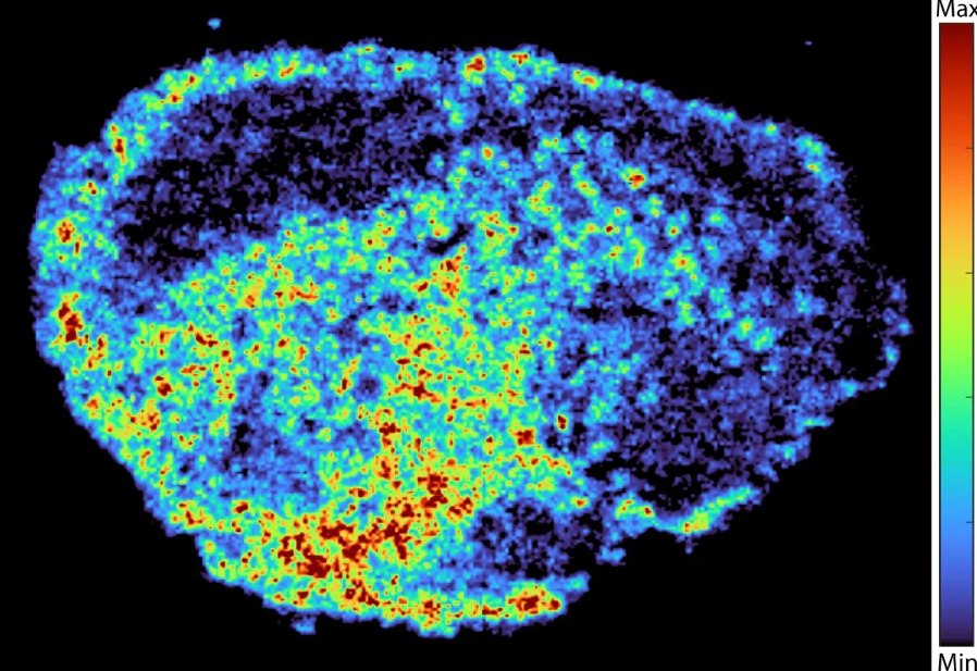 Pse trajtimet e kancerit nuk funksionojnë njësoj për të gjithë?