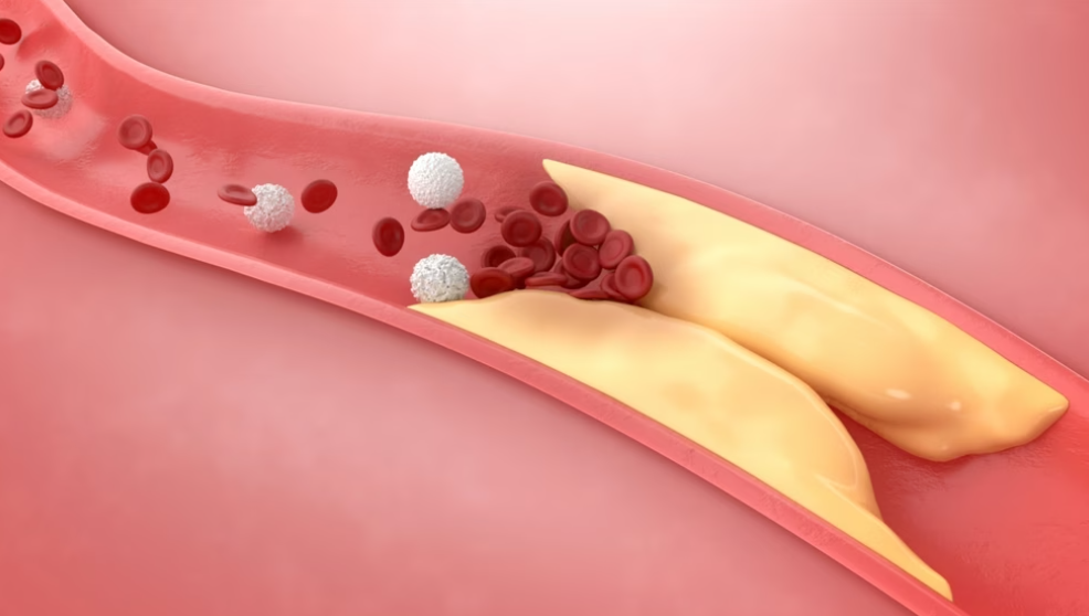 Si krijohet ateroskleroza dhe cilët janë rreziqet kryesore