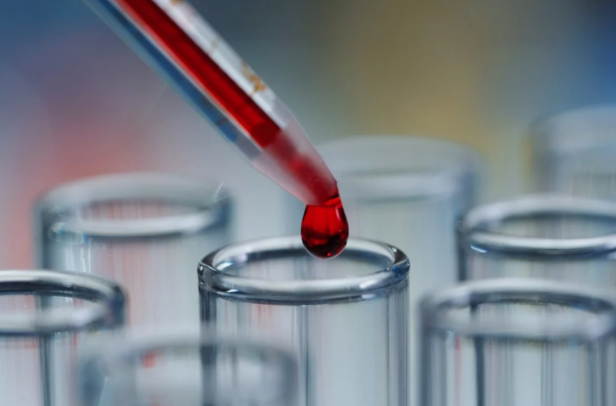 Një analizë gjaku mund të parashikojë rrezikun e demencës deri në 25 vite më herët